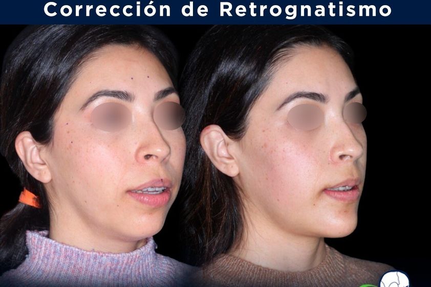Cirugía maxilofacial antes y después - 839174