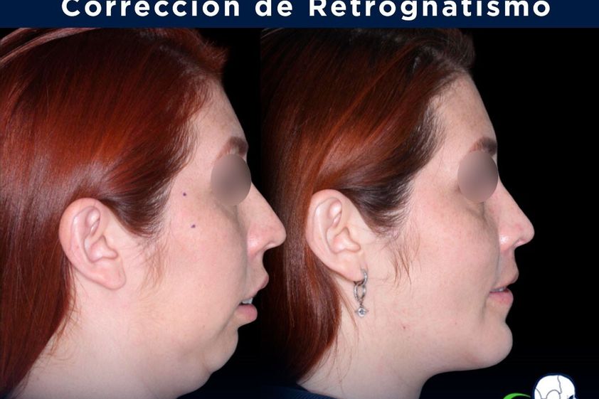Cirugía maxilofacial antes y después - 839175