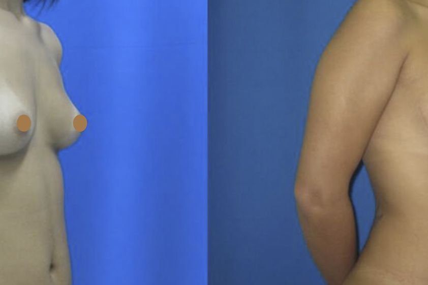 Aumento de busto antes y después - 661037