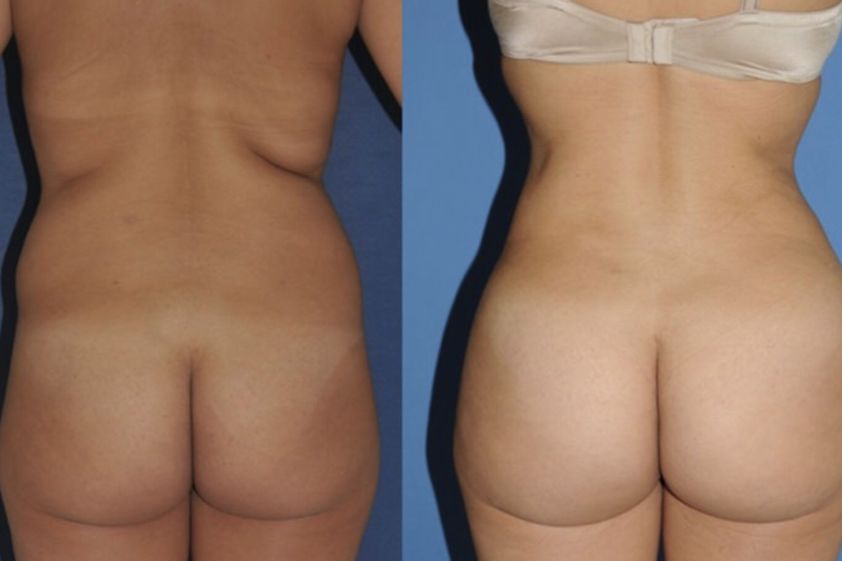 Liposucción antes y después - 661064