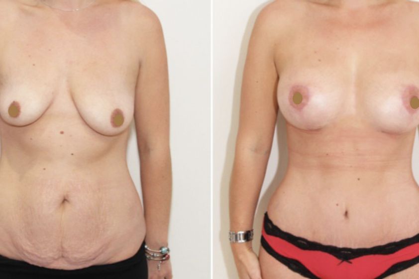 Mastopexia antes y después - 661071