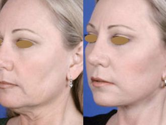 Cirugía facial - 661168