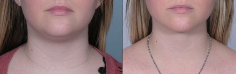 Antes y después de Cirugía de papada
