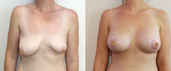 Antes y después de Mastopexia