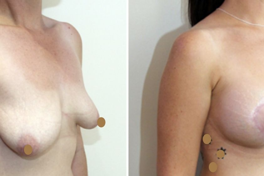 Mastopexia antes y después - 661212