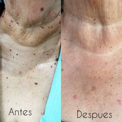 Eliminación de verrugas - Dra. Zuleyma Lili Juarez Gutierrez