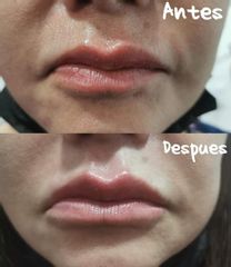 Aumento de labios - Dra. Zuleyma Lili Juarez Gutierrez