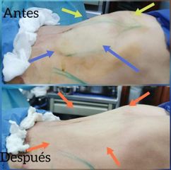 Liposucción - Dra. Zuleyma Lili Juarez Gutierrez