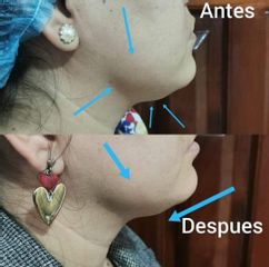 Cirugía de papada - Dra. Zuleyma Lili Juarez Gutierrez