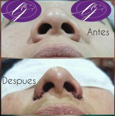 Rinoplastia - Dra. Zuleyma Lili Juarez Gutierrez