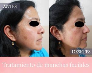 Manchas en la piel - Dra. Zuleyma Lili Juarez Gutierrez