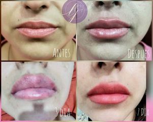 Aumento de labios - Dra. Zuleyma Lili Juarez Gutierrez
