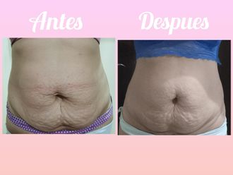 Lipólisis antes y después - 857769