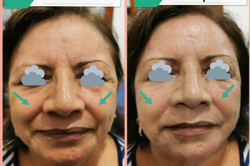 Hilos tensores antes y después - 857773