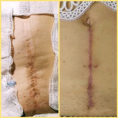 Resección de cicatriz con fibrosis - Dra. Zuleyma Lili Juarez Gutierrez