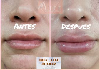 Aumento de labios - Dra. Zuleyma Lili Juarez Gutierrez