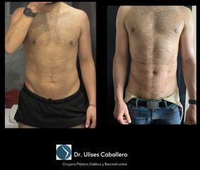 Liposucción - Dr. Ulises Caballero de la Peña