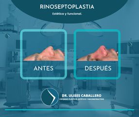 Rinoplastia - Dr. Ulises Caballero de la Peña