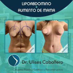 Lipoabdomindoplastia + Aumento de busto  - Dr. Ulises Caballero de la Peña