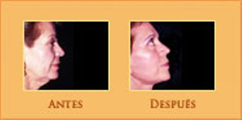 Antes y después de Cirugía de papada y rinoplastia