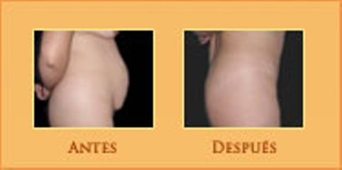 Antes y después de Abdominoplastia