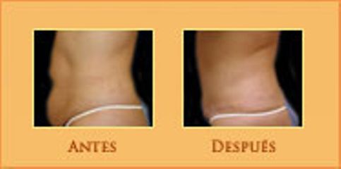 Antes y después de Abdominoplastia