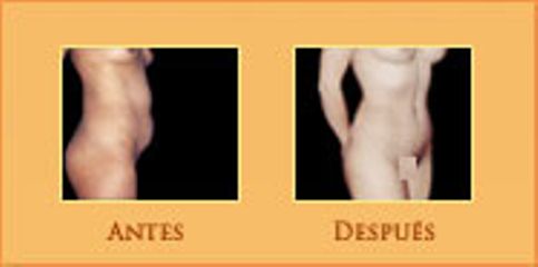 Antes y después de Abdominoplastia