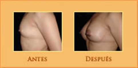 Antes y después de Aumento de busto