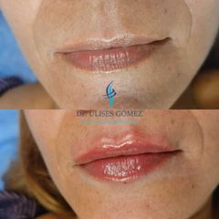 Aumento de labios - Dr. Ulises Gómez