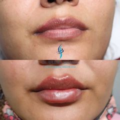 Aumento de labios - Dr. Ulises Gómez