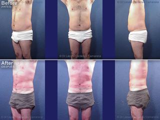 Antes y después de Abdominoplastia