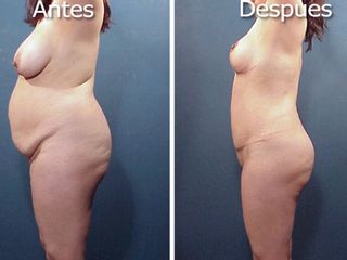 Antes y después de Abdominoplastia