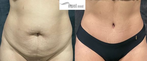 Abdominoplastia - Ngel Med