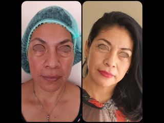 Blefaroplastia - Dr. Peimbert