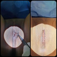 Labioplastia - Dr. Peimbert