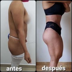 Liposucción - Dr. Peimbert
