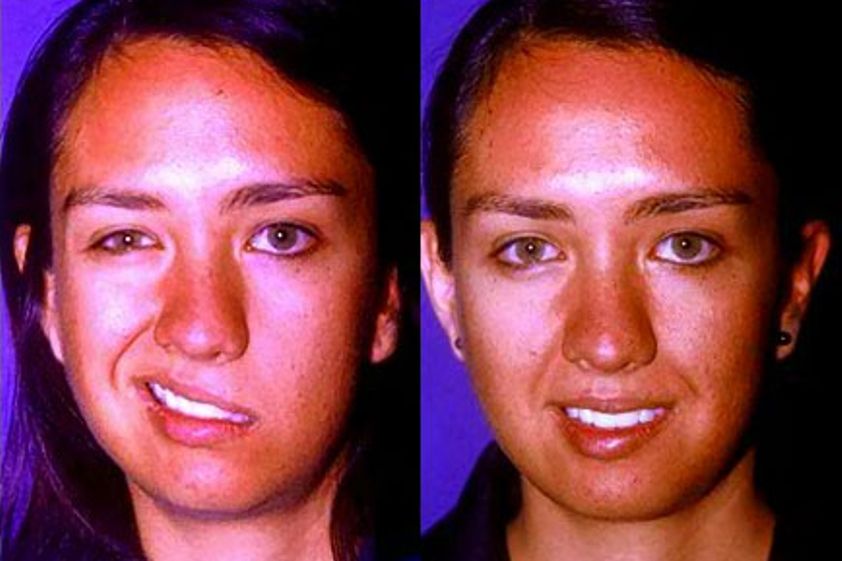 Cirugía maxilofacial antes y después - 205041