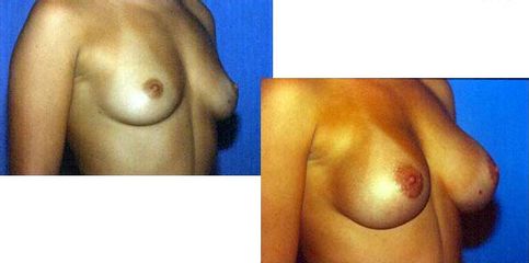 Antes y después de Aumento de busto