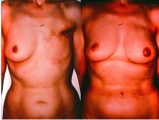 Antes y después de Reconstrucción mamaria