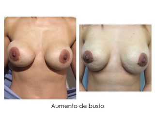 Antes y después de Aumento de busto