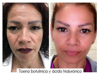 Antes y después de Toxina botulínica
