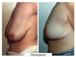 Antes y después de Mastopexia