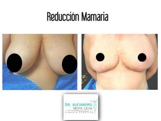 Reducción de mamas - 642879