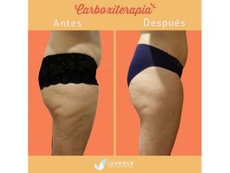 Carboxiterapia antes y después - 642671