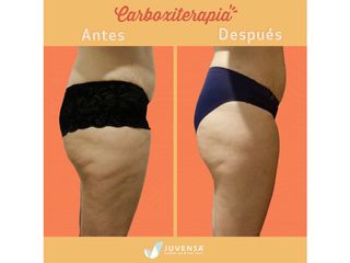 Antes y después de Carboxiterapia