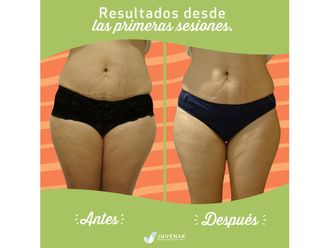 Carboxiterapia antes y después - 642672