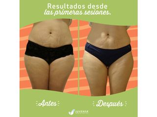 Antes y después de Carboxiterapia