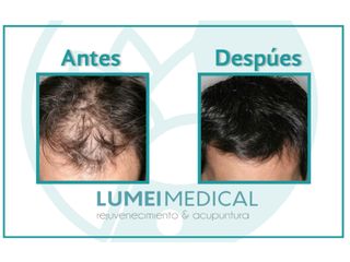 Antes y después de Alopecia