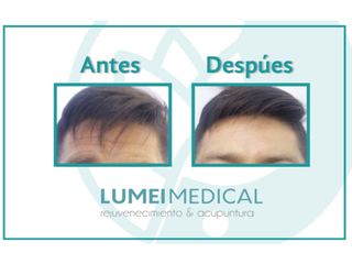 Tratamientos faciales - Lumei Medical