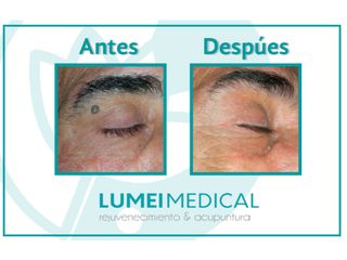 Eliminación de verrugas - Lumei Medical